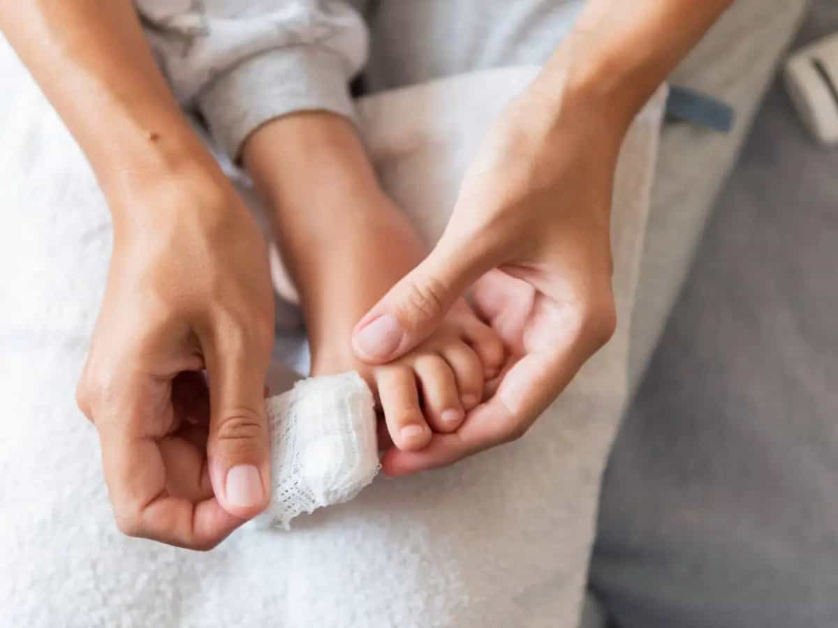 Vesciche, ecco alcuni rimedi naturali